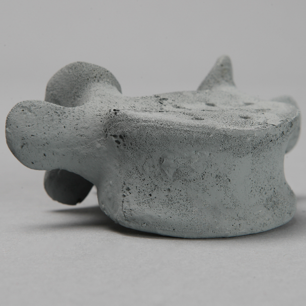 Vertebra, L5, Osteoporotic, Radiopaque