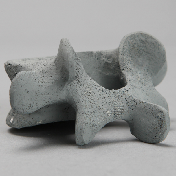 Vertebra, L5, Osteoporotic, Radiopaque
