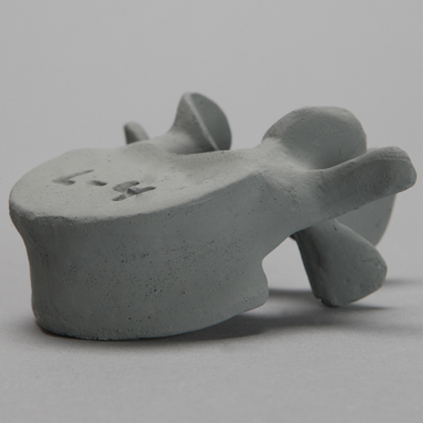 Vertebra, L4, Osteoporotic, Radiopaque