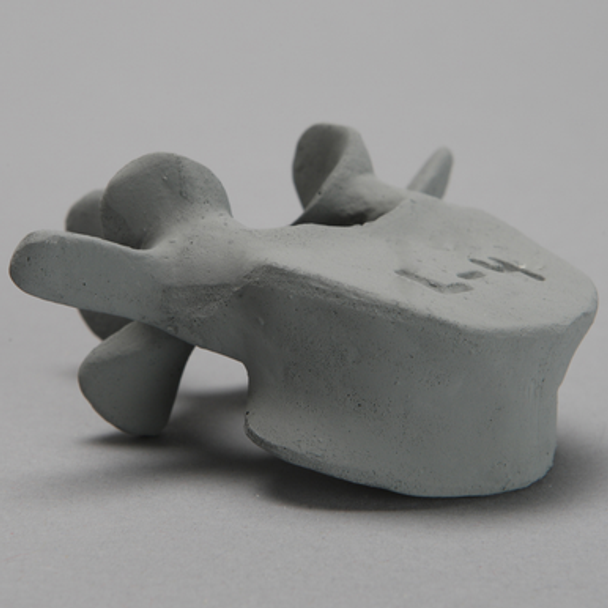 Vertebra, L4, Osteoporotic, Radiopaque