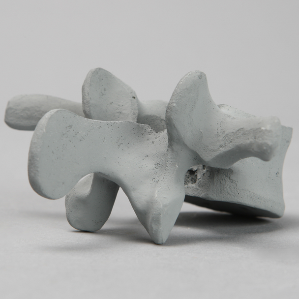 Vertebra, L3, Osteoporotic, Radiopaque