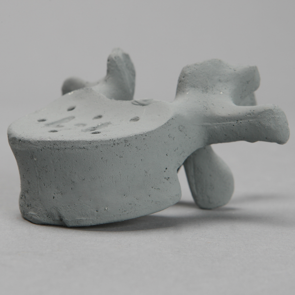 Vertebra, L1, Osteoporotic, Radiopaque