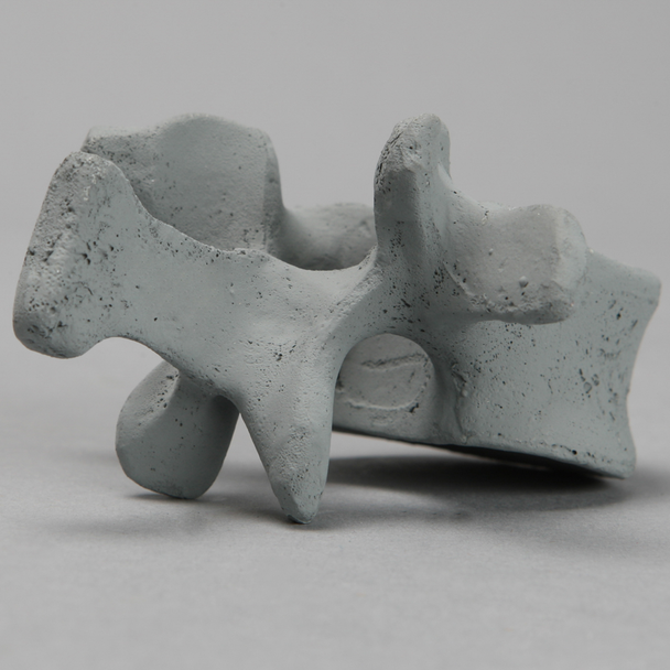 Vertebra, L1, Osteoporotic, Radiopaque
