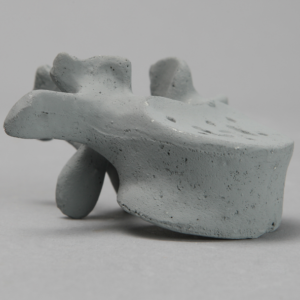 Vertebra, L1, Osteoporotic, Radiopaque