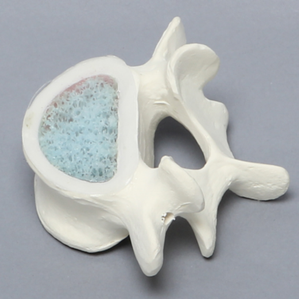 Vertebra, L5, Osteoporotic with Window, Foam Cortical