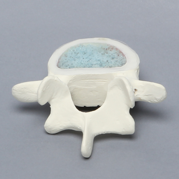 Vertebra, L5, Osteoporotic with Window, Foam Cortical