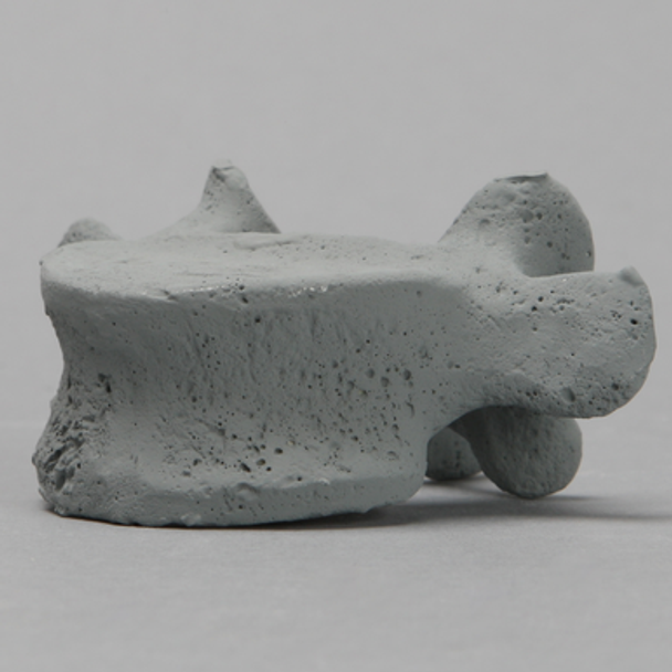 Vertebra, L5, Radiopaque