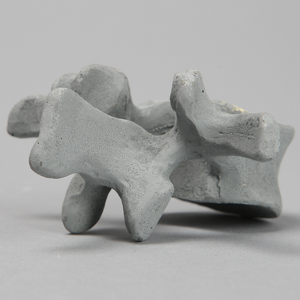 Vertebra, L2, Radiopaque