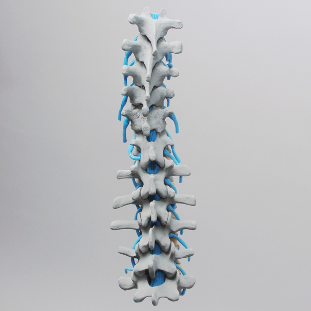 Spine, Lumbar, Osteoporotic Vertebrae with Nerve Roots, Radiopaque