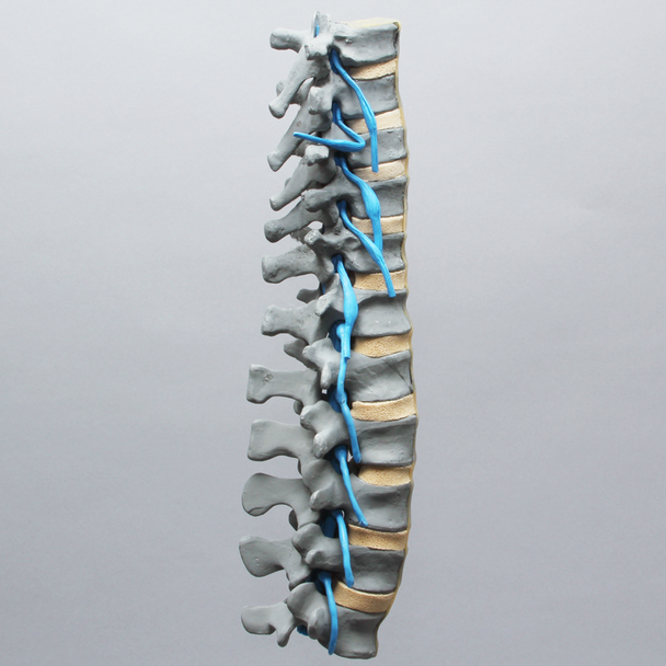 Spine, Lumbar, Osteoporotic Vertebrae with Nerve Roots, Radiopaque