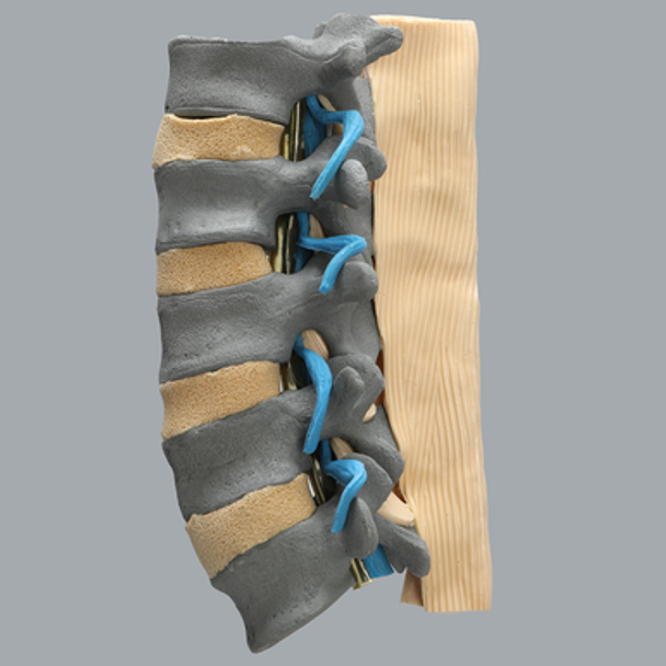 Spine, Lumbar with Nerve Roots, Flava and Interspinous Ligaments, Radiopaque