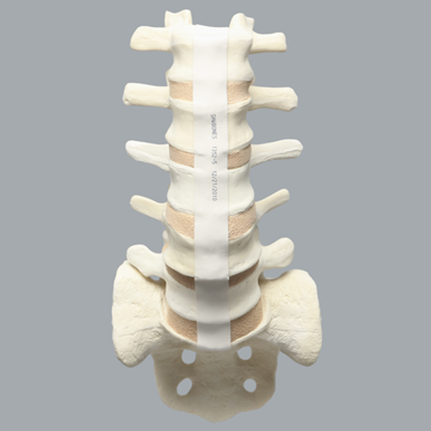 Spine, Lumbar Vertebrae with L4 Spondylolisthesis, Foam Cortical
