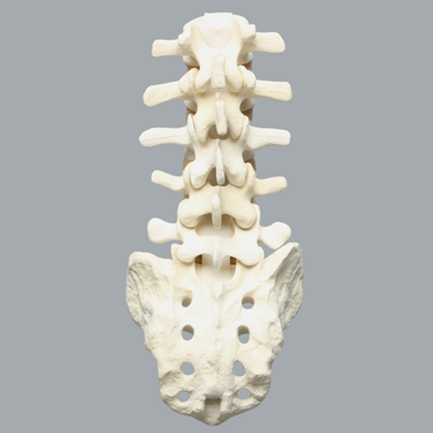 Spine, Lumbar Vertebrae with L4 Spondylolisthesis, Foam Cortical