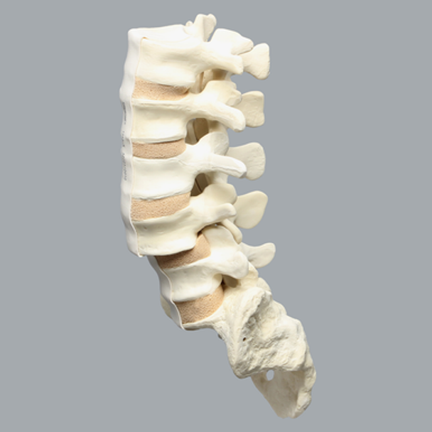 Spine, Lumbar Vertebrae with L4 Spondylolisthesis, Foam Cortical