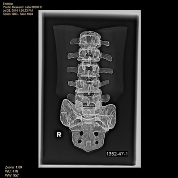 Spine, L1-Sacrum, Lumbar with Muscles, Radiopaque