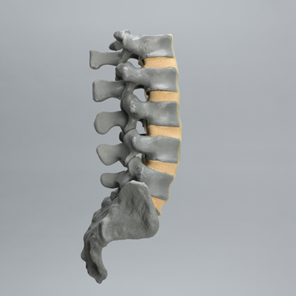 Spine, Lumbar, L1-Sacrum, Osteoporotic Vertebrae, Radiopaque