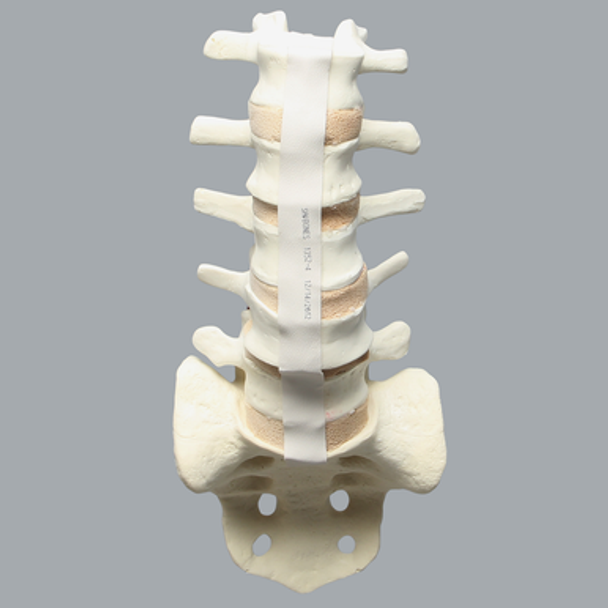 Spine, Lumbar with L4 Spondylolisthesis, Solid Foam