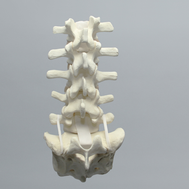 Spine, Lumbar, with L5-Sacrum Grade III Spondylolisthesis