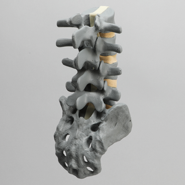 Spine, Lumbar, L2-Sacrum, Radiopaque