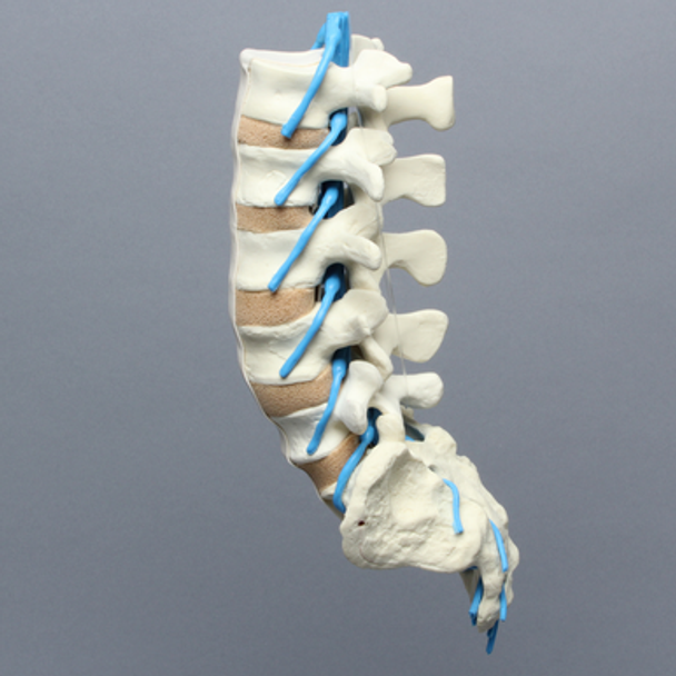 Spine, Lumbar, with L5 Stenosis, Foam Cortical
