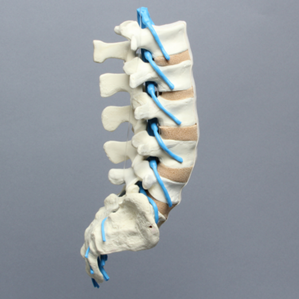 Spine, Lumbar, with L5 Stenosis, Foam Cortical