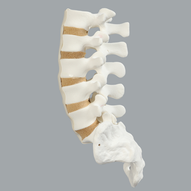 Spine, Lumbar, L1-Sacrum, Foam Cortical Shell