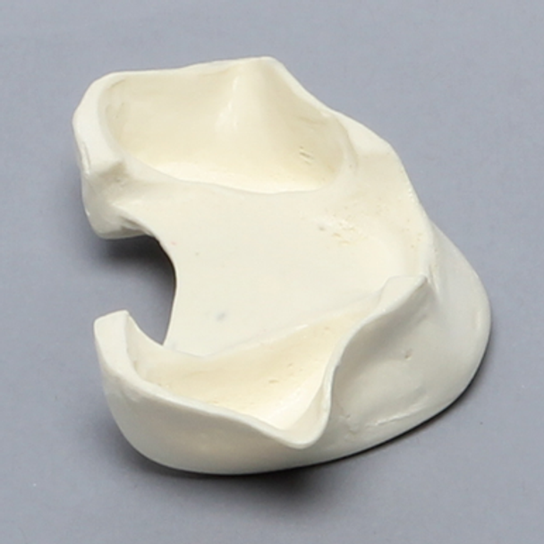 Maxilla, Edentulous