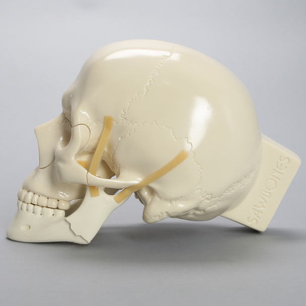 Skull, Full, With Multiple Fractures
