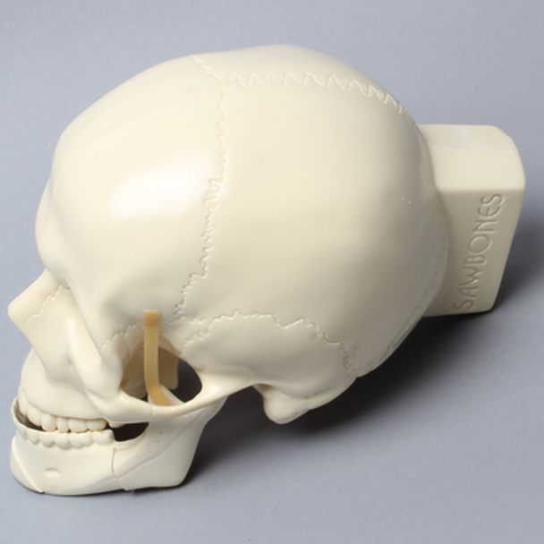 Skull, Full, With Le Fort I Fracture, Sagittal Split, and Genioplasty