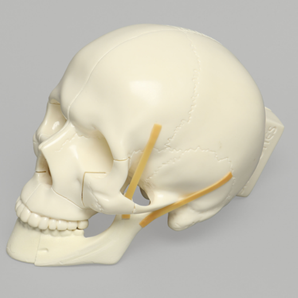 Skull, Full, with All Le Fort Fractures, Solid Foam
