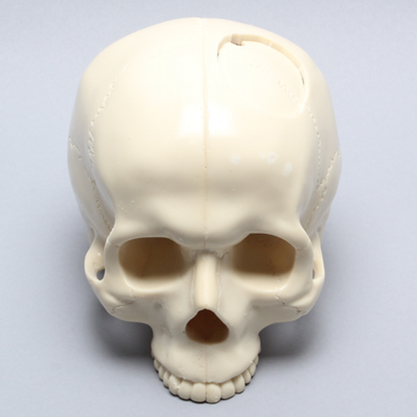 Skull with Craniotomy without Mandible