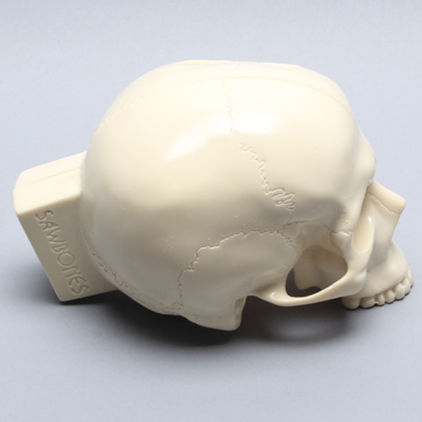 Skull with Craniotomy without Mandible