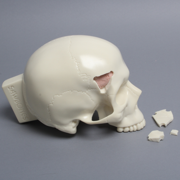 Skull with Fracture and Craniotomies