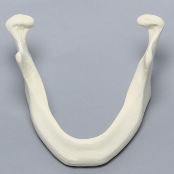 Mandible with Ridge Deformity