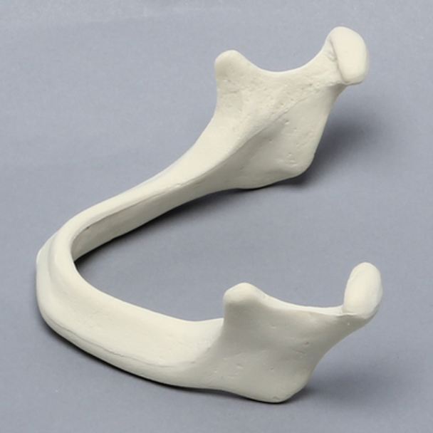 Mandible with Ridge Deformity