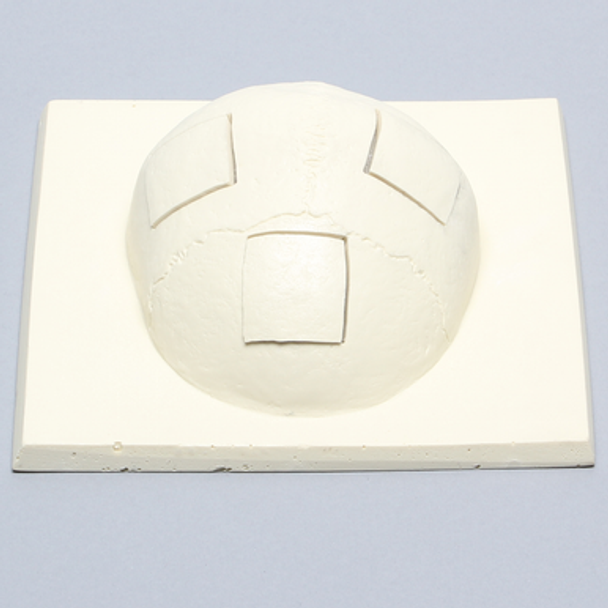 Skull Cap with Three Craniotomies