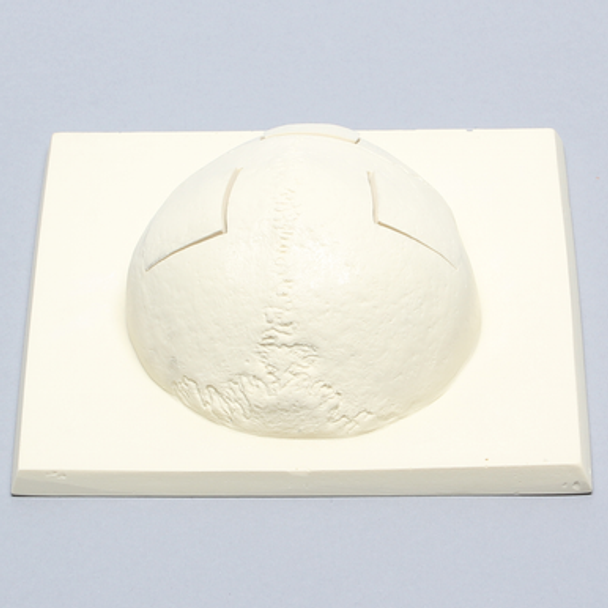 Skull Cap with Three Craniotomies