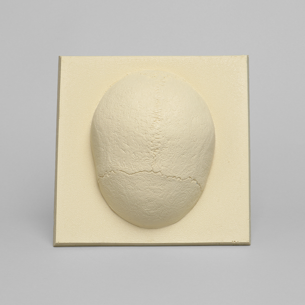 Skull Cap with Dura and Soft Tissue