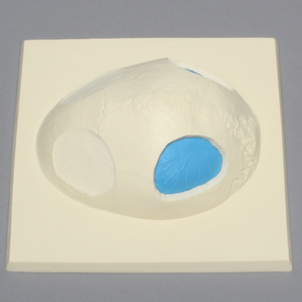 Skull Cap with Dura and Osteotomies