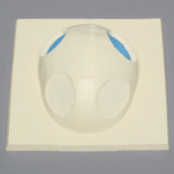Skull Cap with Dura and Osteotomies