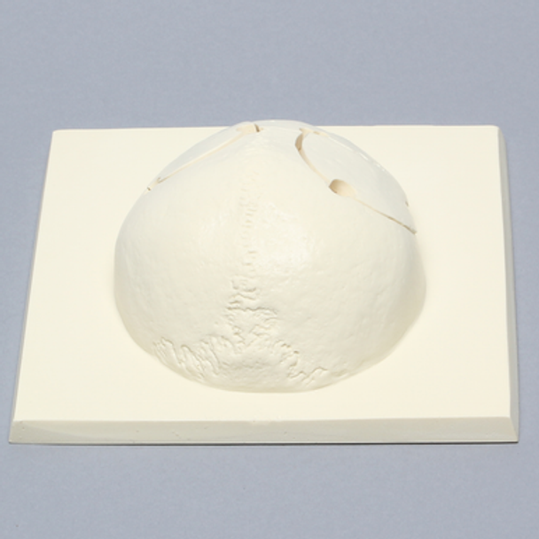 Skull Cap with Bilateral Craniotomies