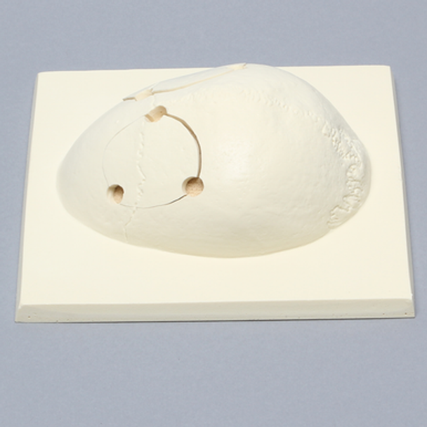 Skull Cap with Bilateral Craniotomies