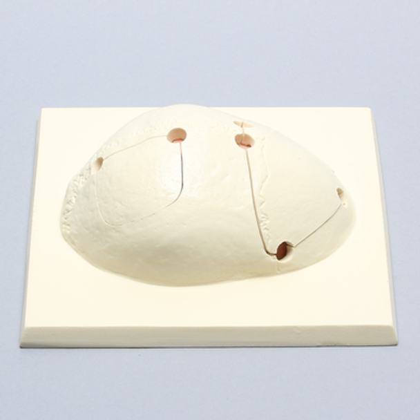 Skull Cap with Craniotomies