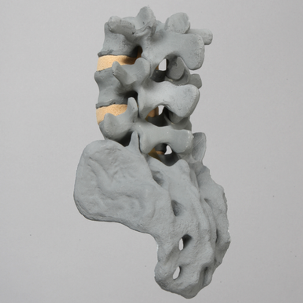 Spine, Lumbar, L3-Sacrum, Radiopaque