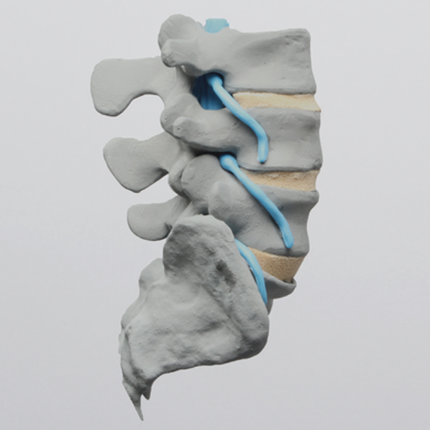 Spine, Lumbar with Partial Sacrum and Nerve Roots, Radiopaque
