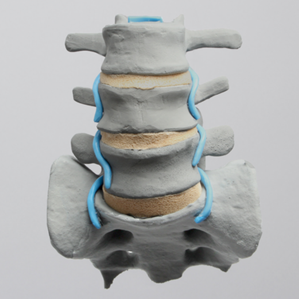 Spine, Lumbar with Partial Sacrum and Nerve Roots, Radiopaque
