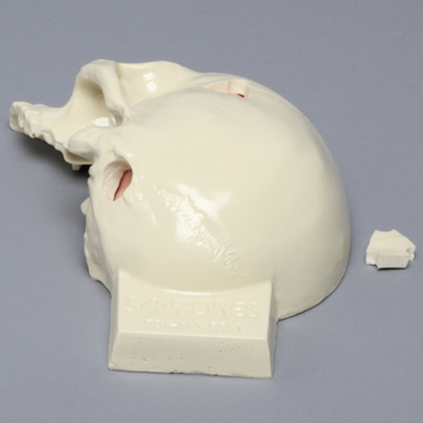 Skull, Half, with Brain and Craniotomies
