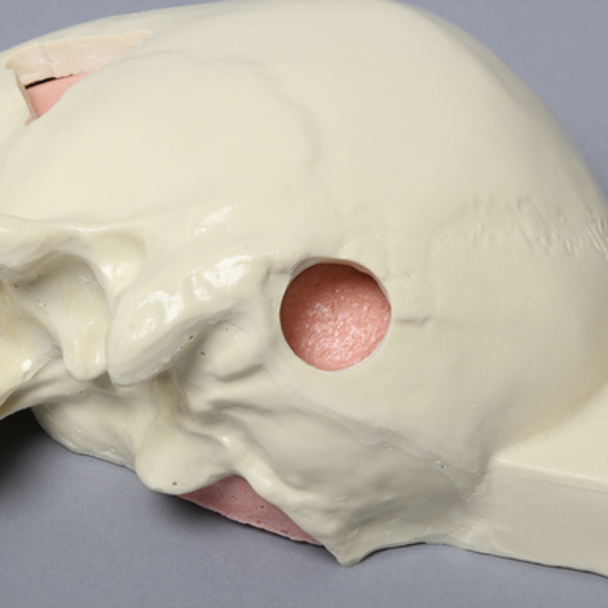 Skull, Half, with Brain and Craniotomies