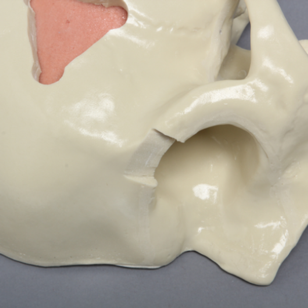 Skull, Half, with Brain and Craniotomies