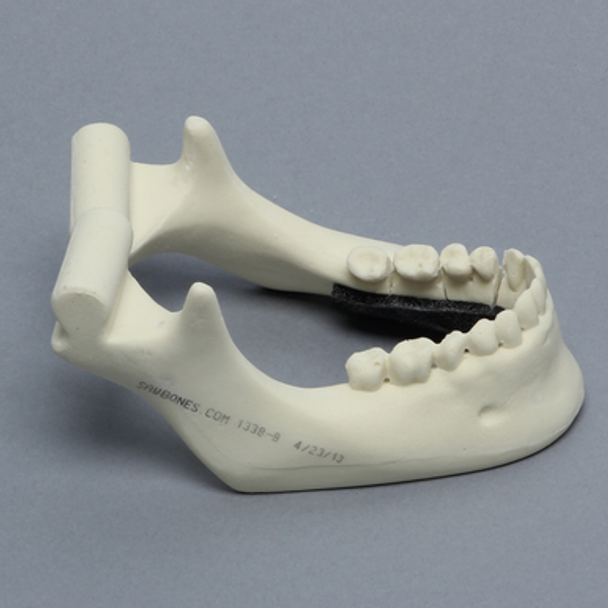 Mandible with Comminuted Fracture